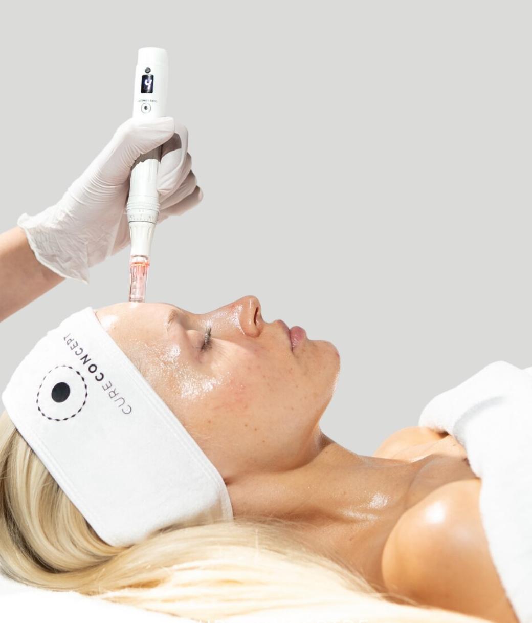 Microneedling-Behandlung mit CureConcept-Gerät im Kosmetikstudio Vanessa Forster