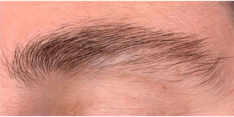 Behandlung Vorher – Beautybar Gersthofen